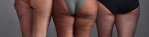 Lipedema