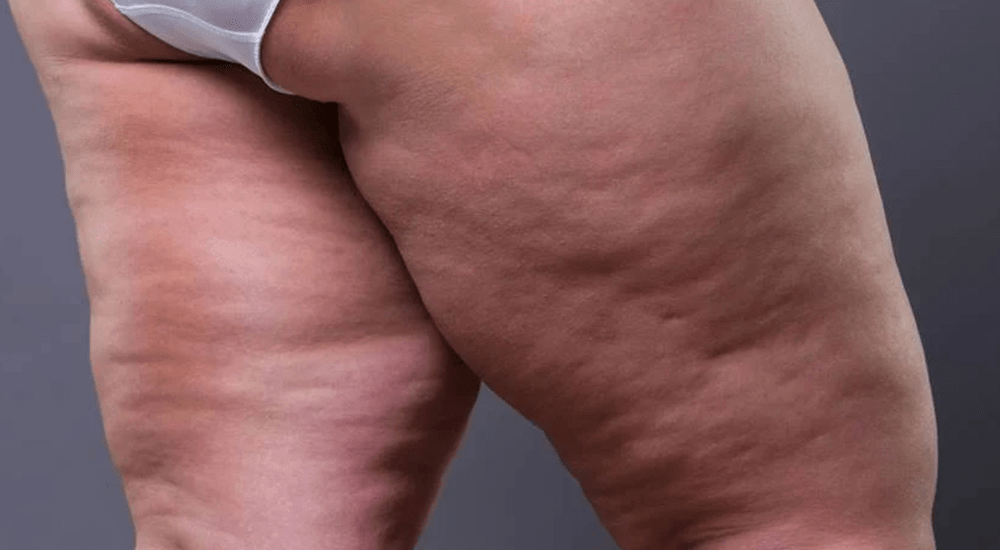 Lipedema na coxa