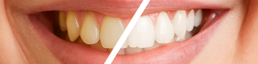 clareamento dental