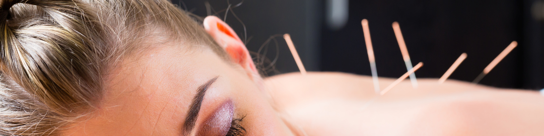 acupuntura