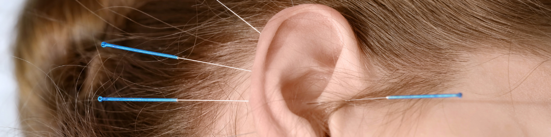 acupuntura auricular