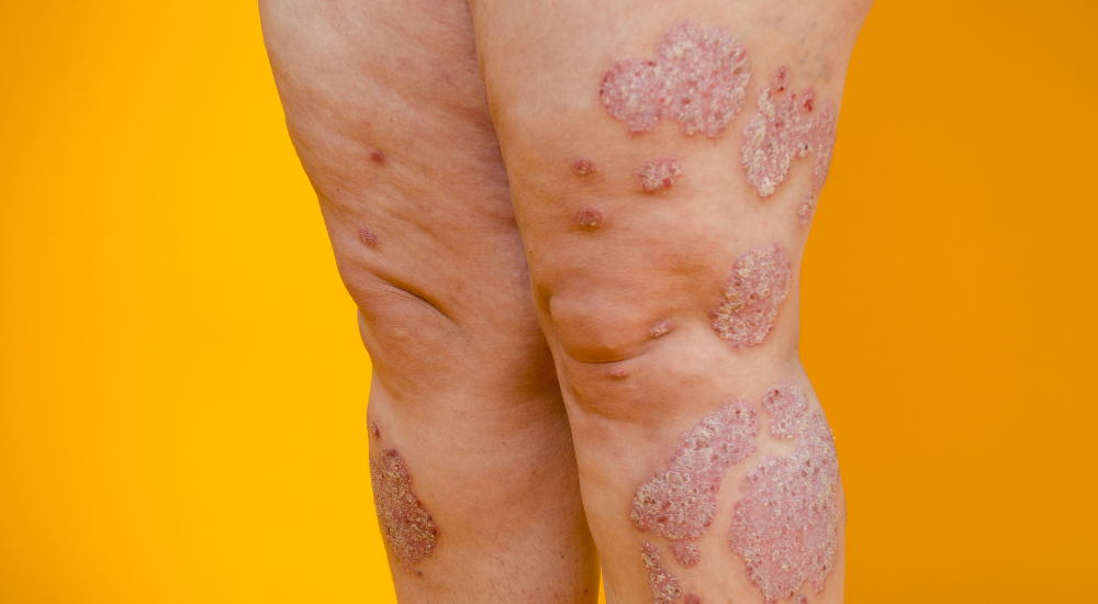psoriase