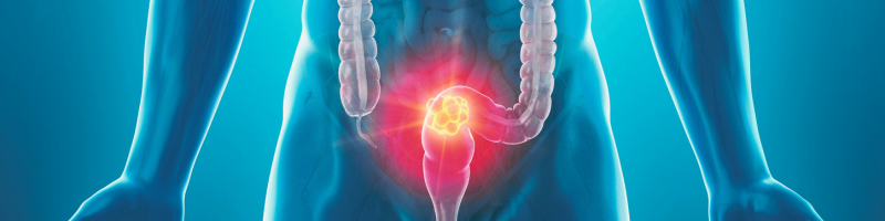 O que é o câncer colorretal