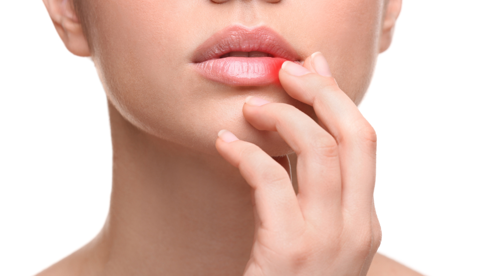 Aftas: Causas, sintomas e tratamentos
