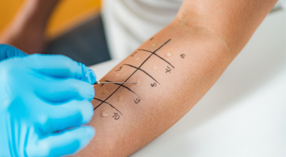 Alergias: Quando é hora de fazer testes