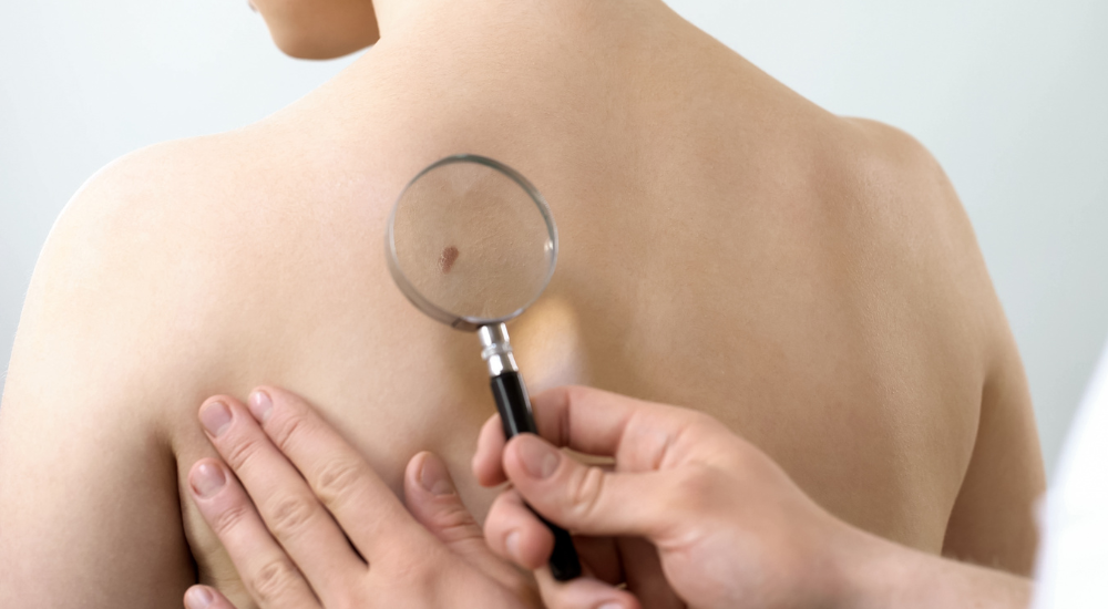 Carcinoma Basocelular: o diagnóstico de Fernanda Rodrigues