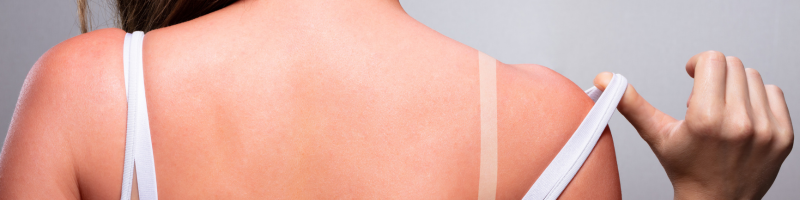 Carcinoma basocelular: Fatores de risco que merecem atenção