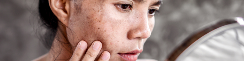 Quais são os sintomas e sinais de alerta do carcinoma basocelular?