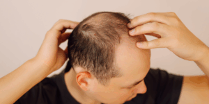 Calvície: conheça as 6 principais causas