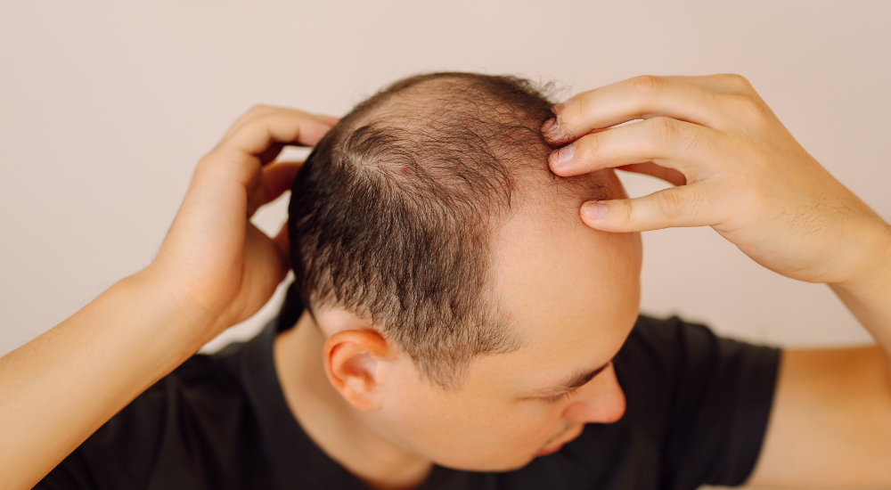 Calvície: conheça as 6 principais causas