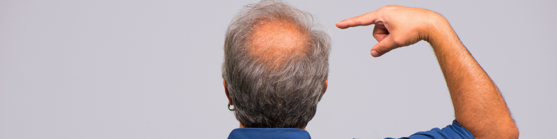 Calvície: Cuidar também é prevenir