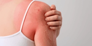 Queimaduras solares e insolação: cuidados para a sua pele