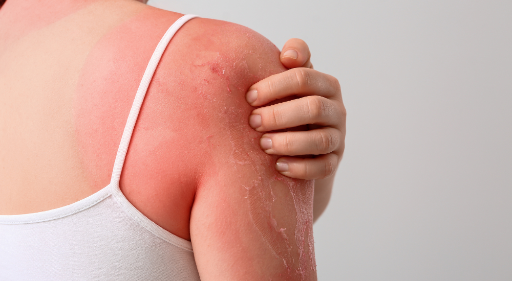 Queimaduras solares e insolação: cuidados para a sua pele