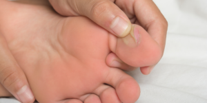 Evitar bolhas: O que fazer com as dores nos pés durante a folia