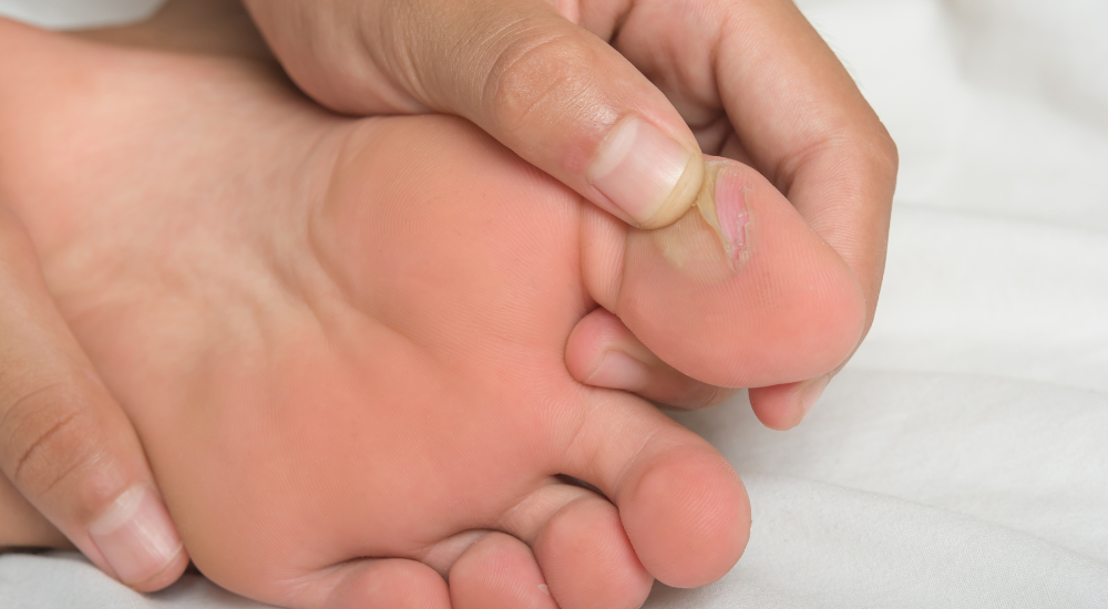 Evitar bolhas: O que fazer com as dores nos pés durante a folia