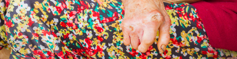 O que é a hanseníase e como ela se espalha O que é a hanseníase e como ela se espalha