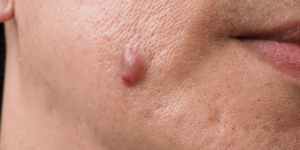 Abscesso o que é, sintomas, causas, tipos e tratamento