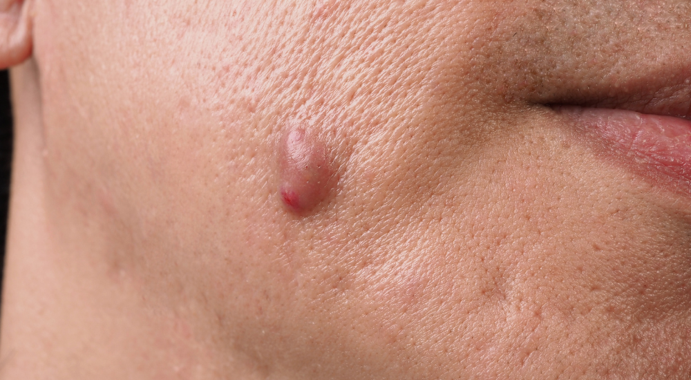 Abscesso o que é, sintomas, causas, tipos e tratamento
