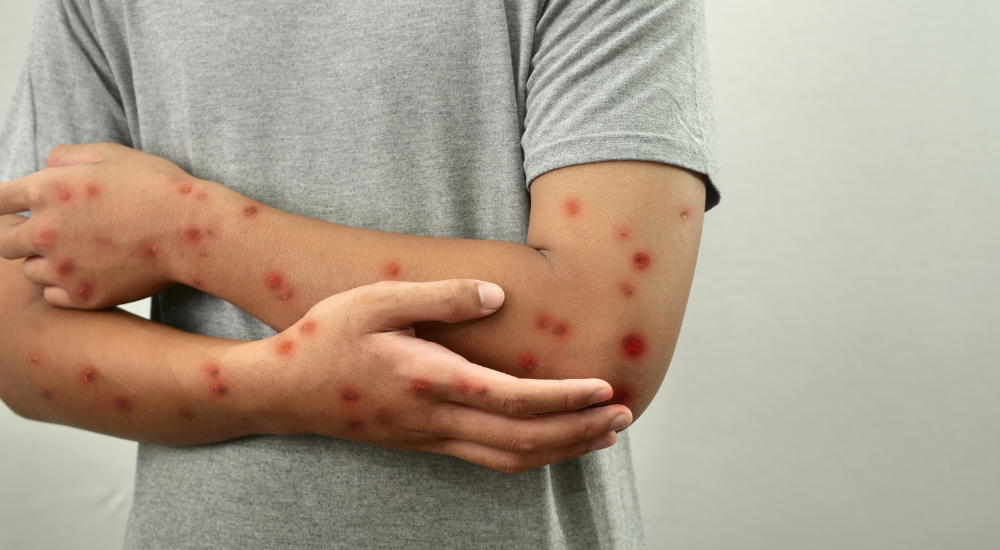 Mpox o que é, sintomas, transmissão, tratamento e prevenção