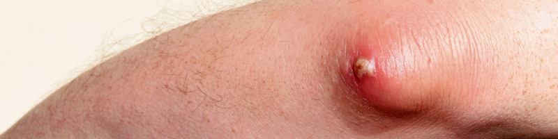 O que é um abscesso O que é um abscesso