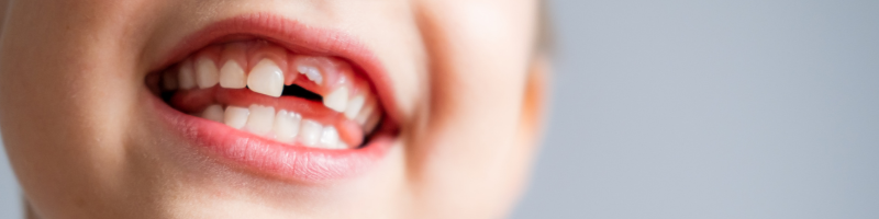 Por que os dentes de leite caem