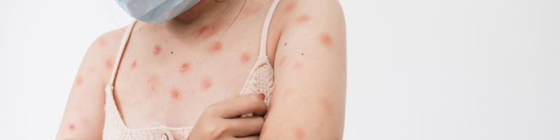 Quais são os sintomas da Mpox Quais são os sintomas da Mpox