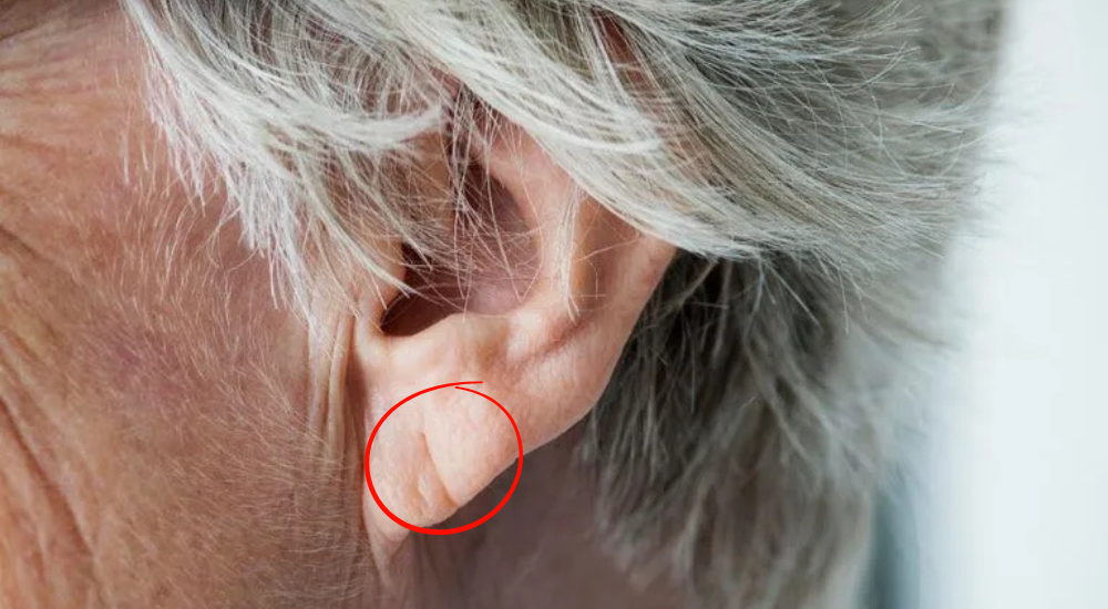 Sinal de Frank e a saúde cardiovascular entenda mais!