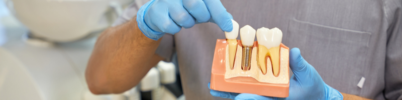 Para que servem os implantes dentários